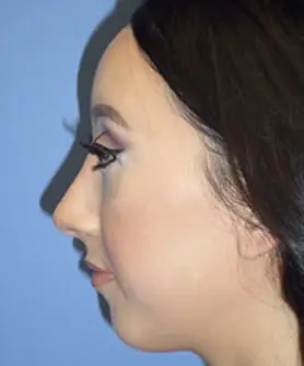42 After Rhinoplasty Before and After Pictures Fayetteville, NC