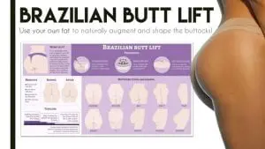 Brazilian Butt Lift in Fayetteville, NC