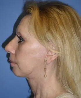 Before and After Pictures in Cary and Fayetteville, NC