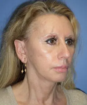 Before and After Pictures in Cary and Fayetteville, NC