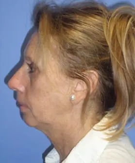 Before and After Pictures in Cary and Fayetteville, NC