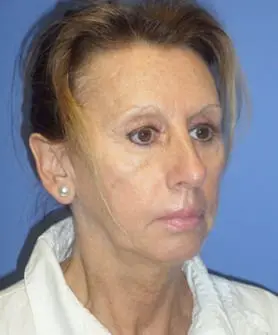 Before and After Pictures in Cary and Fayetteville, NC
