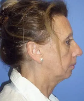 Before and After Pictures in Cary and Fayetteville, NC