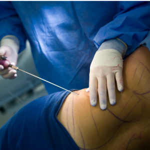 Awake liposuction now in Fayetteville NC, schedule now!