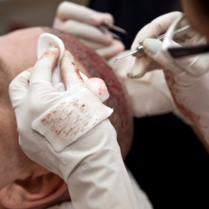 hair transplant - Fayetteville NC