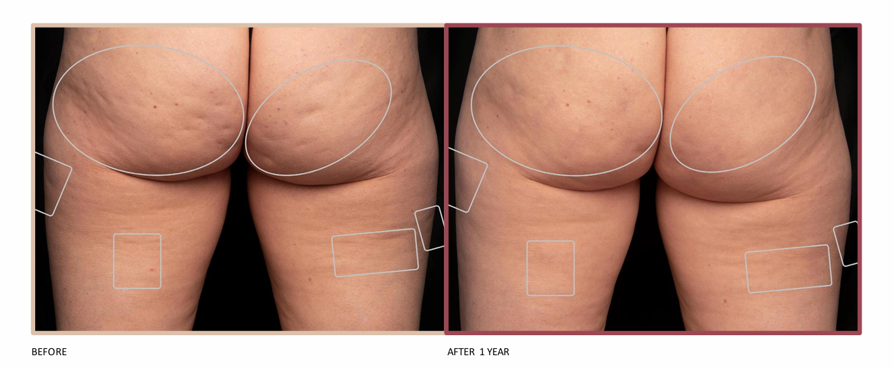 Avéli™ Cellulite Treatment Before and After In Fayetteville, NC