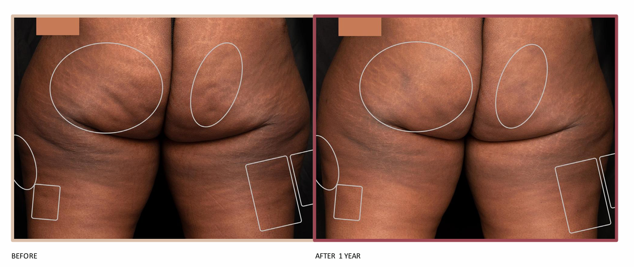 Avéli™ Cellulite Treatment Before and After In Fayetteville, NC