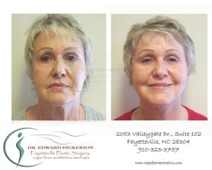 Facelift Before and After Pictures Fayetteville, NC