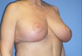 Before and After Pictures in Cary and Fayetteville, NC