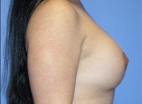 Before and After Pictures in Cary and Fayetteville, NC