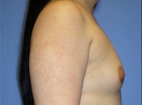Before and After Pictures in Cary and Fayetteville, NC