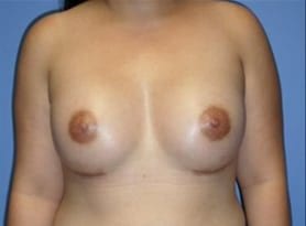 Before and After Pictures in Cary and Fayetteville, NC