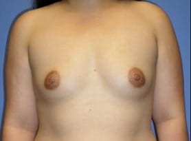 Before and After Pictures in Cary and Fayetteville, NC