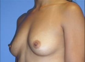Before and After Pictures in Cary and Fayetteville, NC