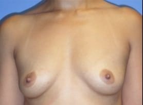 Before and After Pictures in Cary and Fayetteville, NC