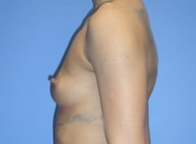Before and After Pictures in Cary and Fayetteville, NC