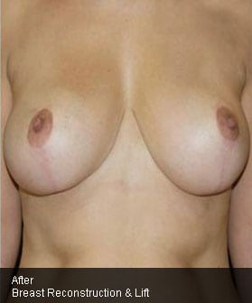 Before and After Pictures in Cary and Fayetteville, NC