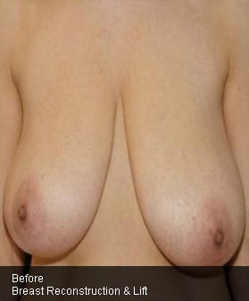Before and After Pictures in Cary and Fayetteville, NC