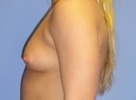 Before and After Pictures in Cary and Fayetteville, NC