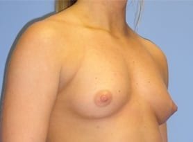 Before and After Pictures in Cary and Fayetteville, NC