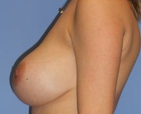 Before and After Pictures in Cary and Fayetteville, NC