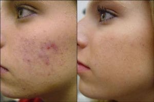Chemical Peels in Fayetteville, NC