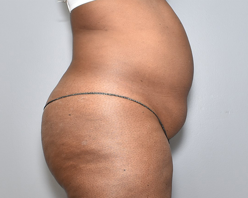 Cost Of Liposuction Austin