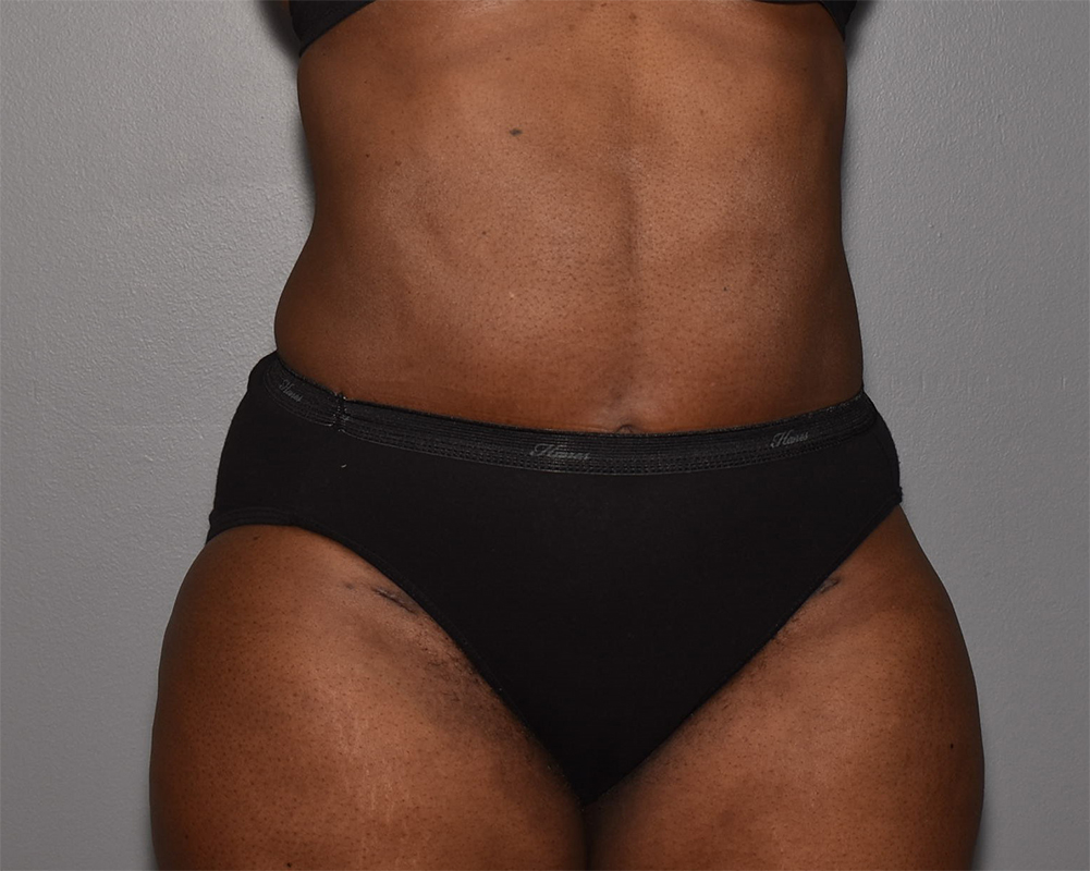 Cost Of Liposuction Austin