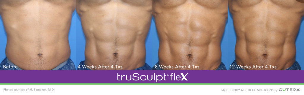 Trusculpt Before and After photos