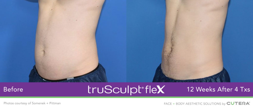 Trusculpt Flex B&A