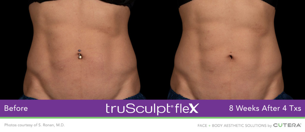 Trusculpt Flex Before and Afters