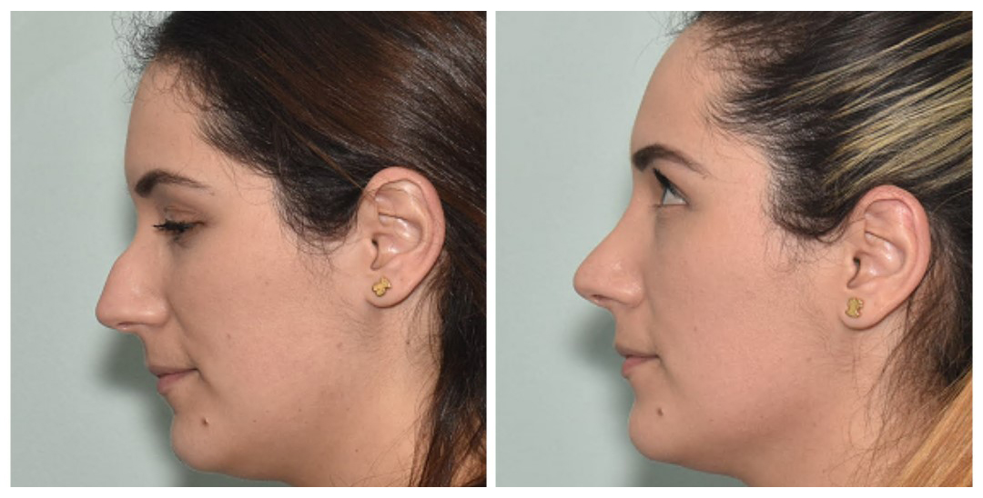 Rhinoplasty Before and After Pictures in Cary and Fayetteville, NC