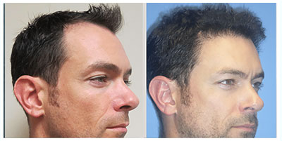 Hair Transplant Before and After Pictures in Cary and Fayetteville, NC