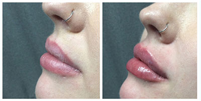 Dermal Fillers & Injectables Before and After Pictures in Cary and Fayetteville, NC