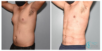 Liposuction Before and After Pictures in Cary and Fayetteville, NC