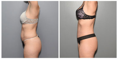 Tummy Tuck Before and After Pictures in Cary and Fayetteville, NC