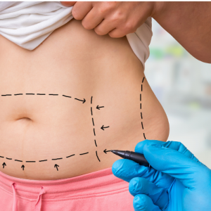 Awake liposuction now in Fayetteville NC, book here!