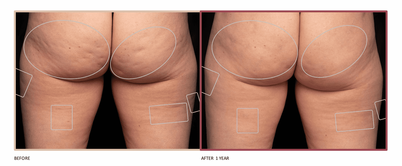 Cellulite 41 Plus 美顔器 Avéli™ Cellulite Treatment In Fayetteville, NC - Dr. Edward Dickerson